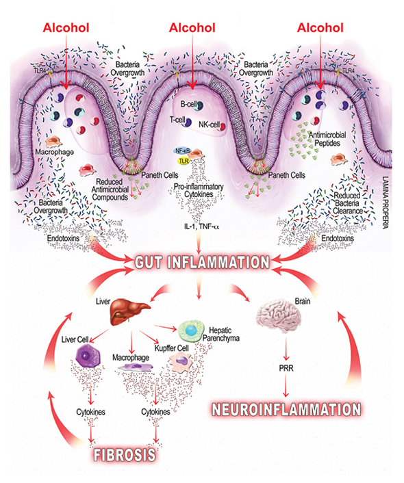 Graphic of alcohol inducing inflammation of the intestine; gut inflammation, neuroinflammation, fibrosis