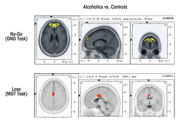 Application of standardized low-resolution brain electromagnetic tomography (sLORETA) to alcoholism.