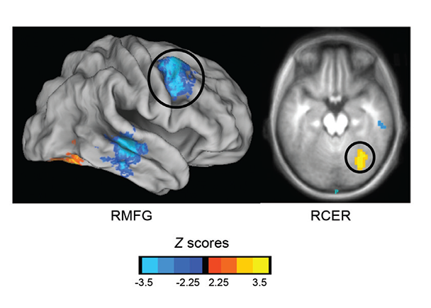 FHP youth have significant differences in right amygdalar resting state functional connectivity patterns compared with FHN youth in frontal and cerebellar regions. 