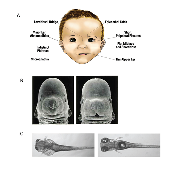 epicanthal fold fetal alcohol syndrome