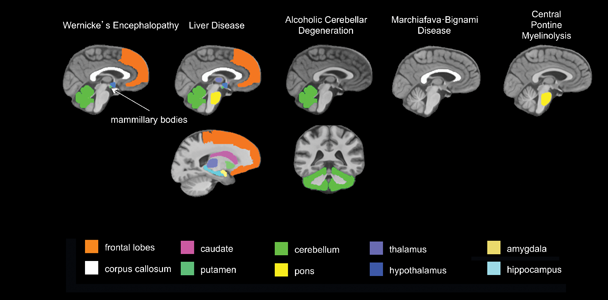 Graphic showing Brain regions targeted by alcoholism-related diseases.