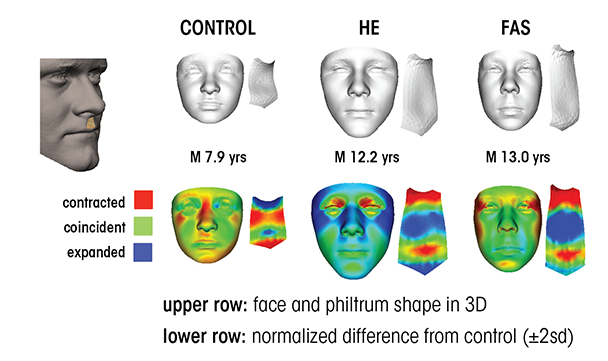 Three-dimensional facial imaging used to detect the effects of prenatal alcohol exposure.