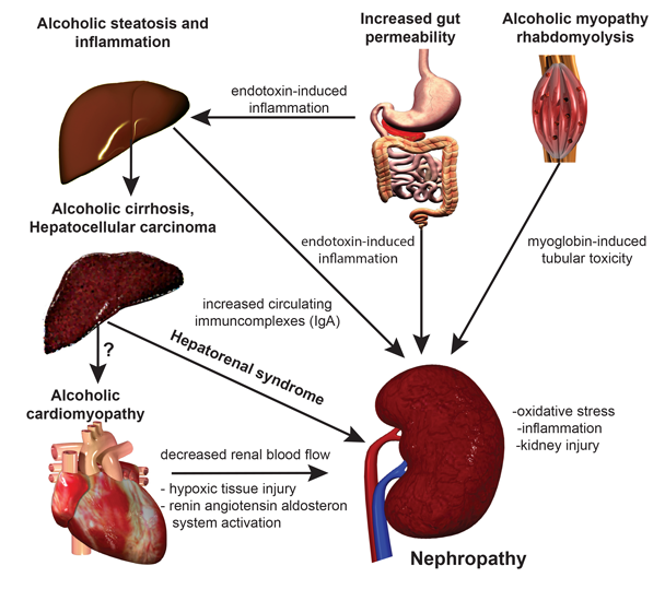 Graphic showing possible mechanism for alcohol-induced kidney injury. Chronic alcohol consumption induces profound injury in several organs that may affect and aggravate the deleterious effect of ethanol on the kidney. Ethanol itself markedly induces the expression of the microsomal ethanol oxidation system (CYP2E1), producing reactive oxygen species as a byproduct. Increased gastrointestinal permeability and endotoxin load may lead to alcoholic steatohepatitis resulting in excessive immunoglobulin A (IgA) 