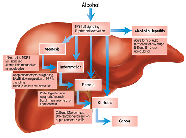 The role of innate immunity in the natural history of alcoholic liver disease (ALD). Heavy alcohol consumption causes release of bacterial products (i.e., lipopolysaccharides [LPSs]) from the gut into the bloodstream. These LPSs lead to activation of liver innate immunity by stimulating Toll-like receptor 4 (TLR 4) signaling on Kupffer cells and hepatocytes. 