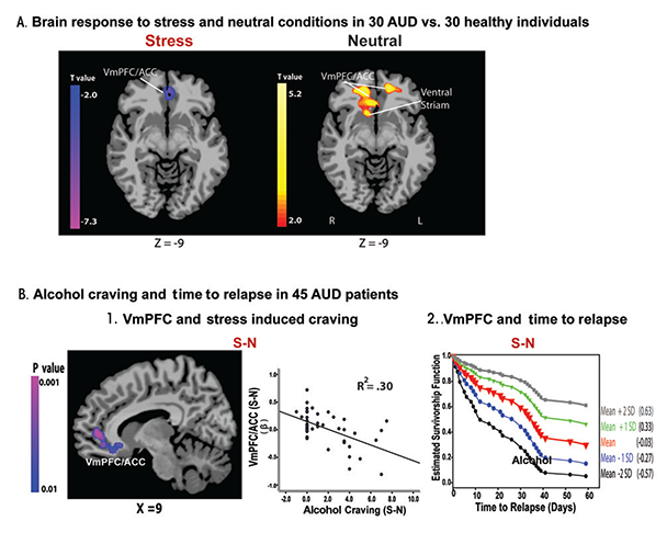 Hypoactive ventromedial prefrontal cortex (VmPFC) response to stress, alcohol craving, and relapse risk