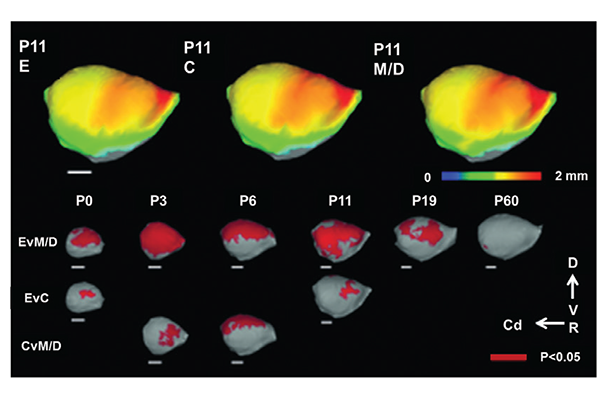 Regional pattern of cerebral cortical thickness differences result from threshold-free cluster enhancement (TFCE) analysis