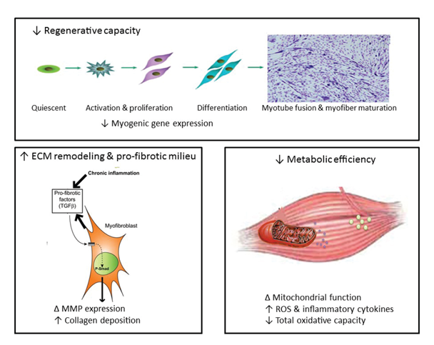 Graphic showing Mechanisms contributing to alcohol-induced loss of muscle mass and impairment in muscle growth. Decreased skeletal-muscle regenerative capacity is reflected as decreased myogenic gene expression, which prevents satellite-cell differentiation and myotube fusion and myofiber maturation. Chronic heavy alcohol consumption leads to skeletal-muscle inflammation, which favors expression of profibrotic factors such as transforming growth factor ß (TGF-ß), stimulating an increase in the expression and activation (phosphorylation) of transcription factors such as Smad (P-Smad). This in turn results in altered gene expression of matrix metalloproteinases (MMPs) and increased collagen deposition in the extracellular matrix (ECM) of skeletal muscle, which can prevent adequate satellite-cell activation, proliferation, and differentiation. Direct and indirect evidence indicates that alcoholic myopathy is associated with decreased mitochondrial function, enhanced reactive oxygen species (ROS) generation, and decreased total oxidative capacity, particularly in type 2 fibers. An increased proinflammatory and oxidative milieu in skeletal muscle likely is the underlying mechanism leading to the decreased regenerative capacity, development of a profibrotic milieu, and diminished metabolic efficiency.