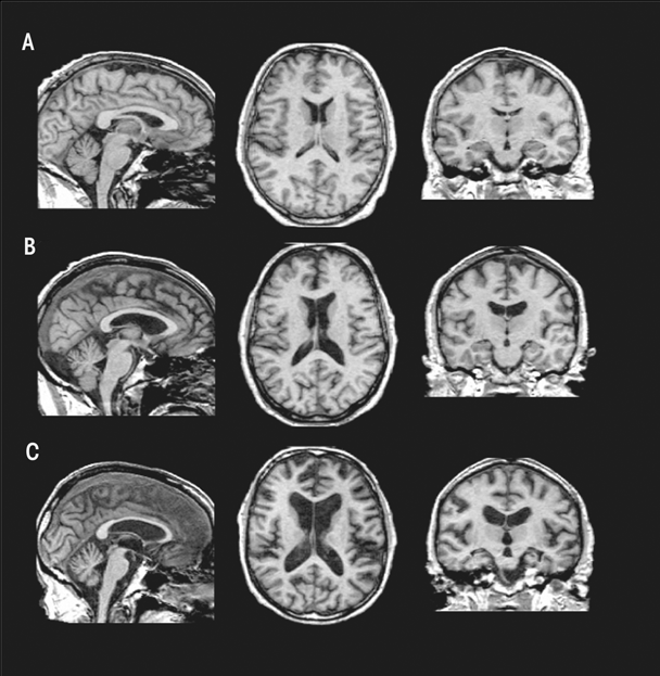 Graphic showing Brain volume deficits in a healthy control (A) compared with a subject with uncomplicated alcoholism (B) and a subject with Korsakoff’s syndrome (KS) (C). These structural MRIs show a graded effect of volume deficits, notable in the ventricular and sulcal cerebrospinal fluid (CSF)–filled spaces: subjects with KS > subjects with uncomplicated alcoholism > normal controls.