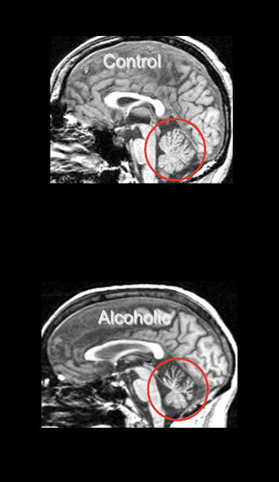 Graphic showing Cerebellar volume deficits in uncomplicated alcoholism. Midsagittal view of the brain, showing smaller volume of the anterior superior vermis of the cerebellum in an alcoholic man (bottom) compared with an age-matched control man (top).