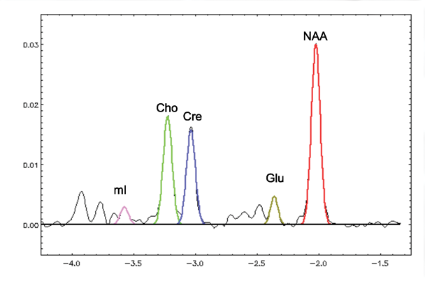 Graphic showing Magnetic resonance spectroscopy spectra from the thalamus of a 55-year-old nonalcoholic control woman, with a gaussian fit of the major metabolites that has been color coded.