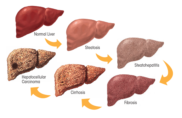 Graphic showing Spectrum of alcoholic liver disease. Heavy ethanol consumption produces a wide spectrum of hepatic lesions. Fatty liver (i.e., steatosis) is the earliest, most common response that develops in more than 90 percent of problem drinkers who consume 4 to 5 standard drinks per day. With continued drinking, alcoholic liver disease can proceed to liver inflammation (i.e., steatohepatitis), fibrosis, cirrhosis, and even liver cancer (i.e., hepatocellular carcinoma).