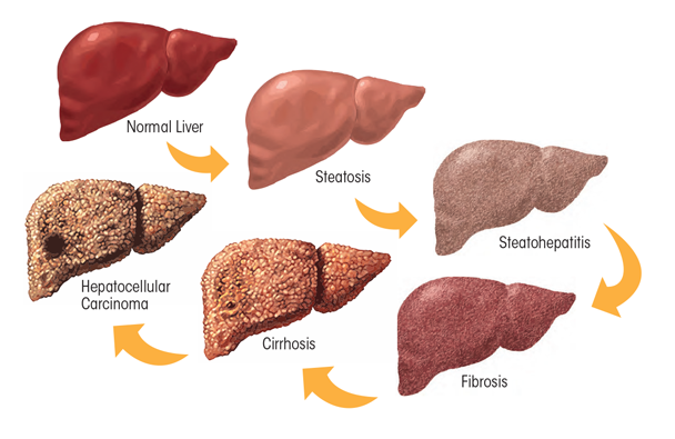 effects of alcohol on liver