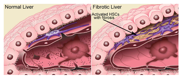 Graphic showing Hepatic stellate cells (HSCs) are key players in the development of fibrosis. HSCs normally reside in the space of Disse as quiescent, lipid (retinyl-ester)-storing cells. Chronic ethanol consumption initiates a complex activation process that transforms these quiescent HSCs into an activated state. Activated HSCs secrete copious amounts of the scar-forming extracellular matrix proteins. This, in turn, contributes to structural changes in the liver, such as the loss of hepatocyte microvilli and sinusoidal endothelial fenestrae, ultimately causing the deterioration of hepatic function.