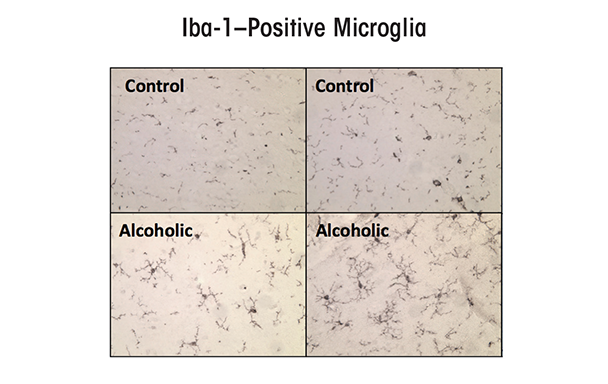 Microglial activation, as indicated by expression of the microglial marker Iba-1, is increased in postmortem alcoholic brain. 