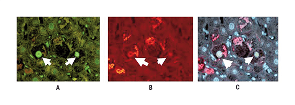 Histone deacetylase 1 (HDAC1) is upregulated in the nuclei of liver cells (i.e., hepatocytes) that form Mallory-Denk bodies (MDBs), which are indicative of liver damage. The image shown is from a liver biopsy from a patient with alcoholic hepatitis. The liver section was IHC double stained for HDAC1 (green nuclei arrows) (A), ubiquitin to identify cells with MDBs (red, arrows) (B), and tricolor (C). Magnification: ×350. 