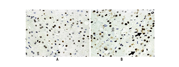 The signaling molecule p27 is upregulated in the nuclei of liver cells (i.e., hepatocytes) in a liver biopsy from two patients with alcoholic hepatitis. The livers were stained with an immunoperoxidase-labeled antibody that recognizes p27. The hepatocyte nuclei positive for p27 appear brown; those that are negative for p27 appear blue. (A and B) Most of the nuclei stained positive. (B) The Mallory-Denk bodies (MDBs) also stained brown (arrows), indicating that p27 also is sequestered in the MDBs. Magnificat