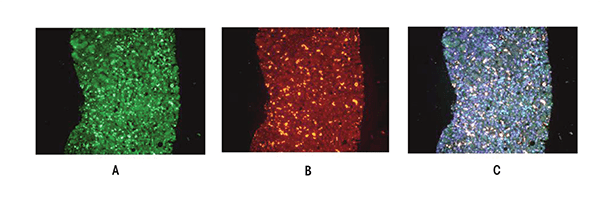 These images show a double-immunostained liver biopsy from a patient with alcoholic hepatitis where most of the hepatocytes had formed Mallory-Denk bodies (MDBs). The MDBs stained positive for (A) pEZHZ (green), (B) ubiquitin (red), and (C) merged (yellow), indicating that the pEZH2 colocalized in the MDBs. Magnification ×350. 