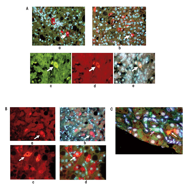 Analysis of different marker proteins in stem cell/progenitor cells located in the livers of patients with alcoholic liver disease with cirrhosis and associated hepatocellular carcinoma (HCC). (A) Liver cirrhosis and HCC samples stained for both YAP-1 (green) and IGF2bp3 (red). a) Cirrhosis; b) HCC (magnification ×350); c) HCC; d) HCC; e) Tricolor image merged from c and d (magnification ×525). (B), a and b) Liver cirrhosis sample double stained for Nanog (green) and SOX2 (red). Note the Mallory-Denk bodies