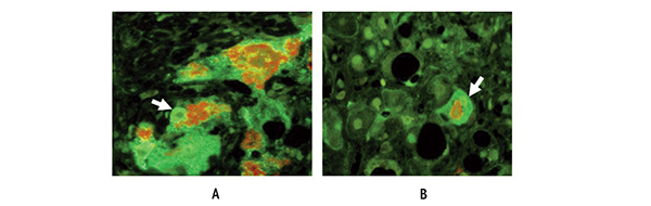 Immunohistochemical analysis of a liver biopsy obtained from a patient with alcoholic hepatitis with Mallory-Denk body (MDB) formation. The samples were stained for the presence of CD49f (integrin subunit α6) (green) and ubiquitin (red). Note that the MDBs stain both red for ubiquitin and green for CD49f. The arrows point to the nuclei that stain green except for the nucleolus. The yellow fringe on the MDB indicates colocalization of both proteins at the interface of the MDBs.