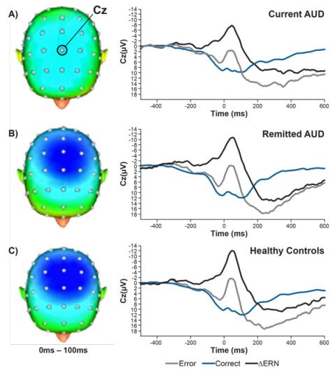  Error-related neural activity among (A) people with current AUD, (B) people with remitted AUD, and (C) healthy controls. 